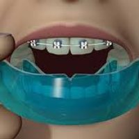 Mouthguards-for-Braces.jpg